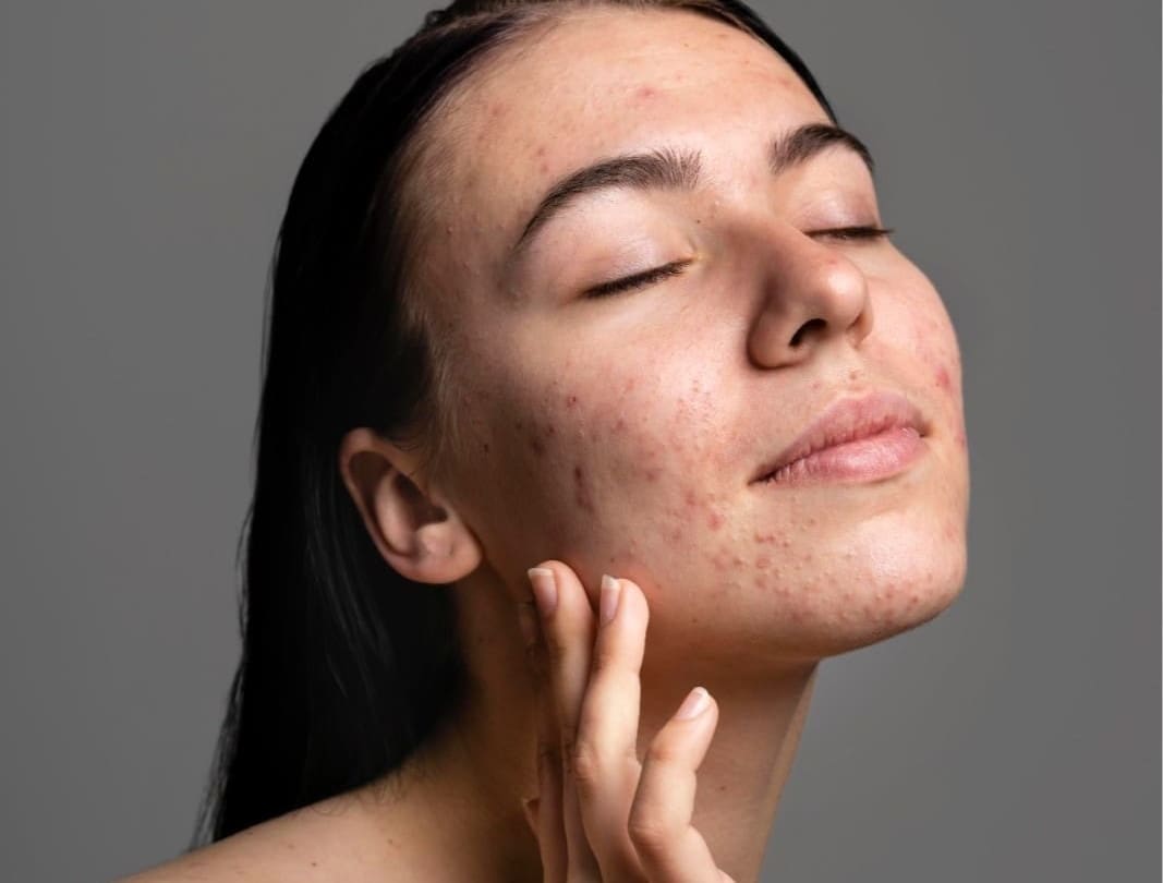 Active Acne: Causes, Prevention, Treatments at Dr Hass Clinic