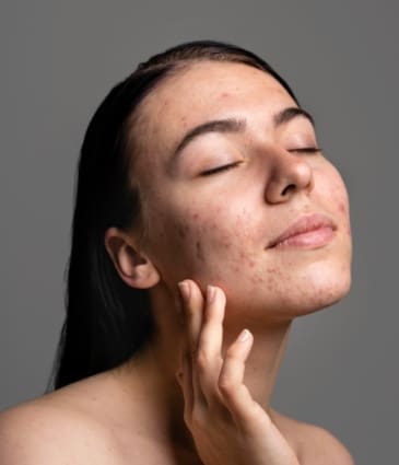 Active Acne: Causes, Prevention, Treatments at Dr Hass Clinic