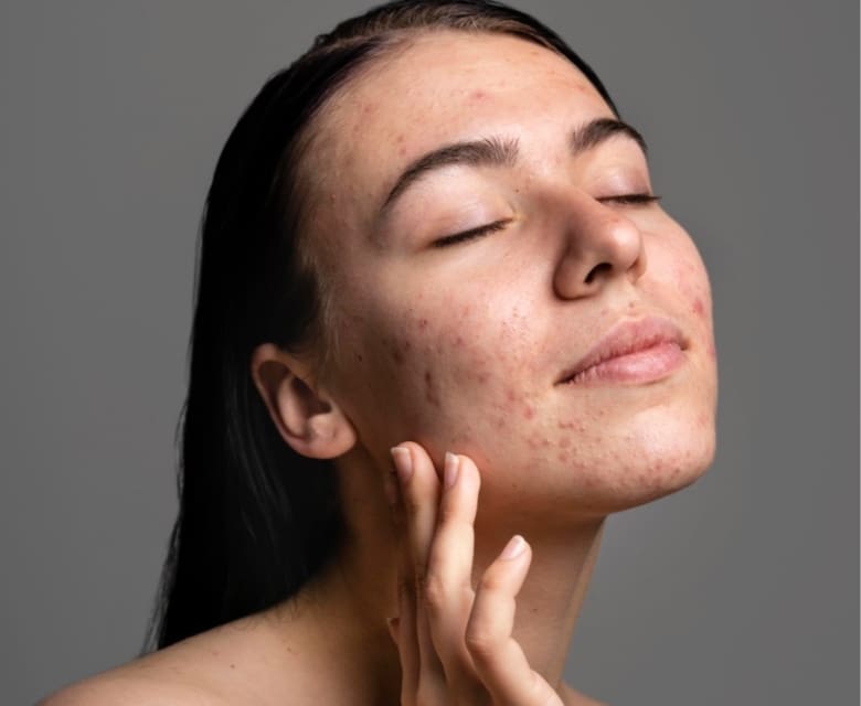 Active Acne: Causes, Prevention, Treatments at Dr Hass Clinic