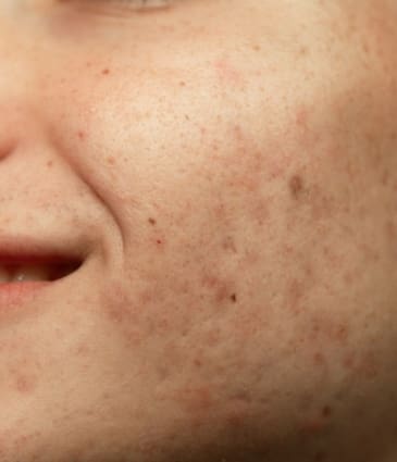 Hyperpigmentation Condition | Causes, Prevention and Treatments