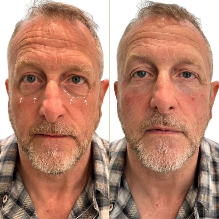 under eye filler London result