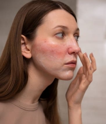 woman-looking-her-rosacea-mirror