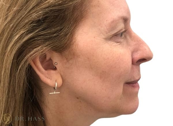Dr Hass - Profile Balancing
