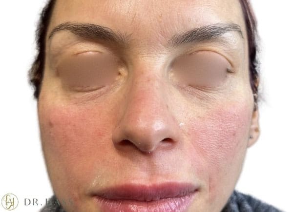 Dr Hass - Tear Trough Filler after