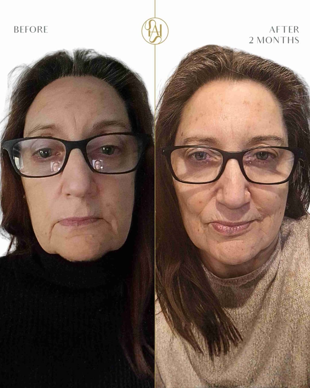 Endolift 70 years old