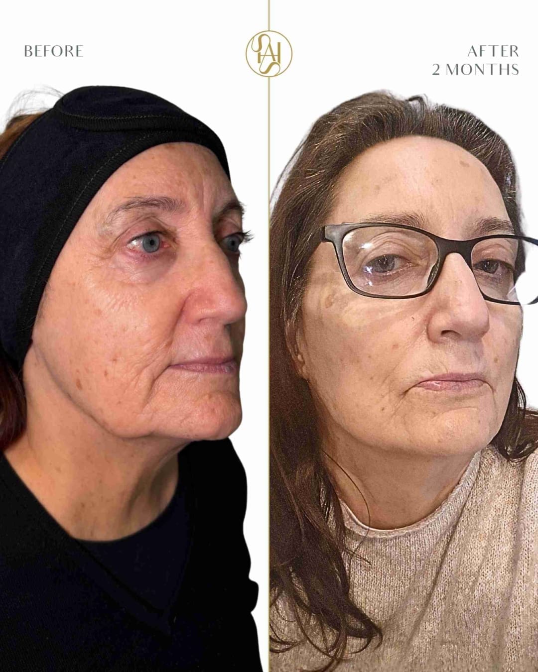 Endolift 70 years old