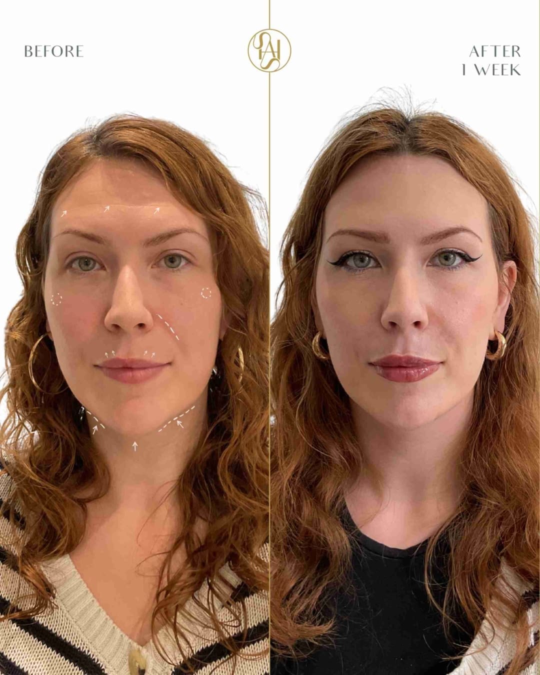Full Face Rejuvenation London - Full facial rejuvenation