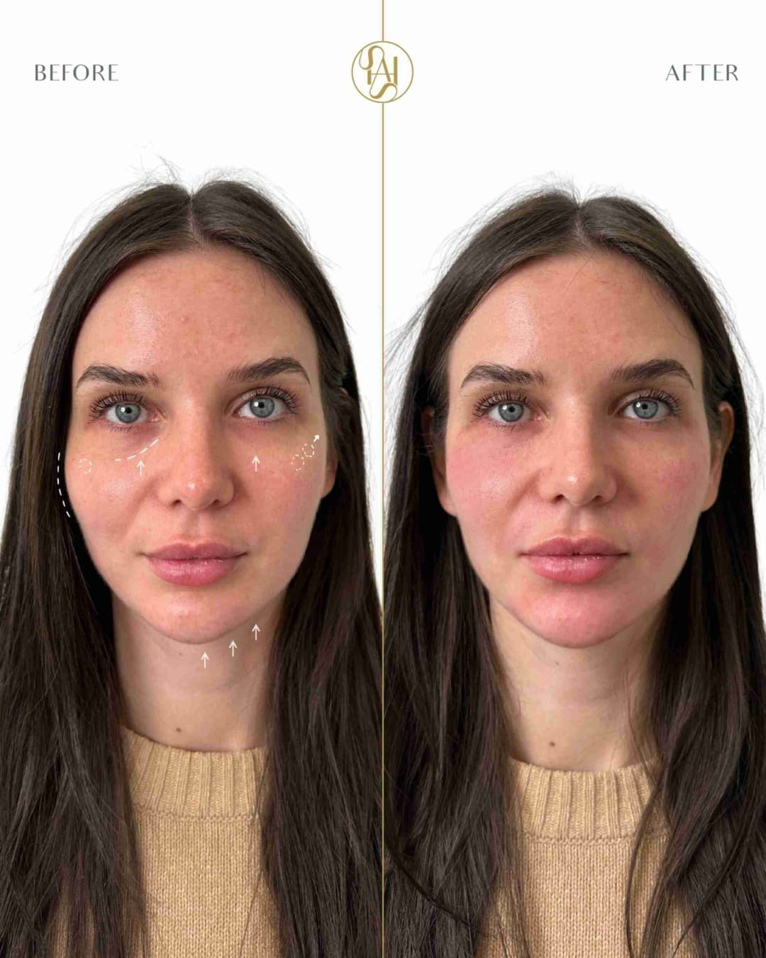Full Face Rejuvenation London - Full facial rejuvenation