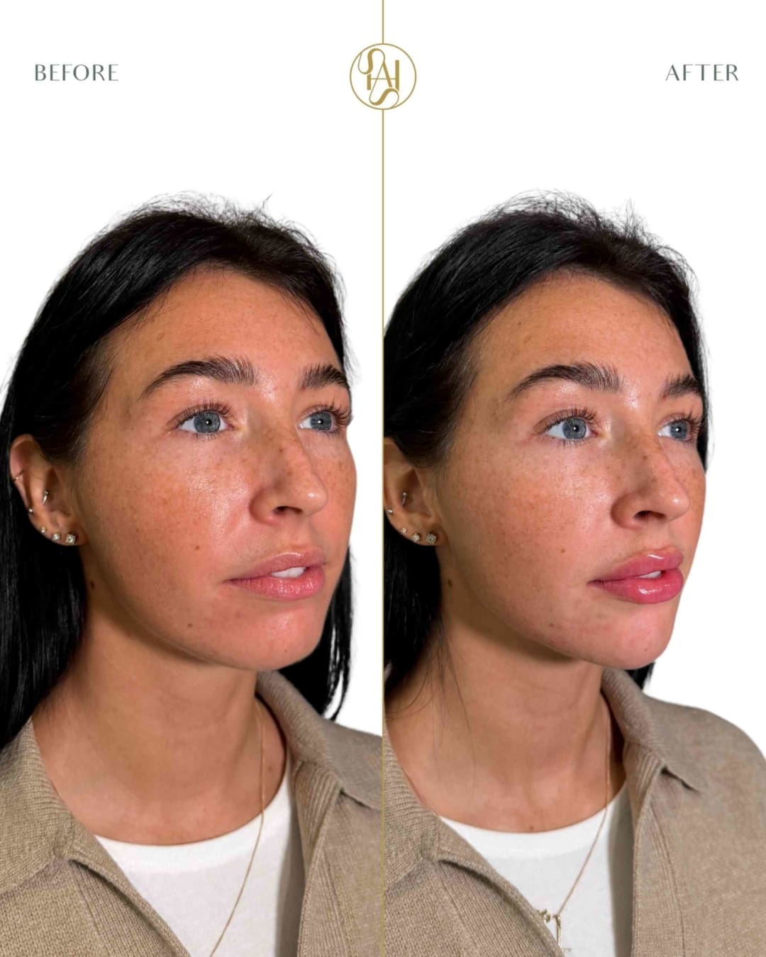 Profile Balancing London - Lower Face rejuvenation