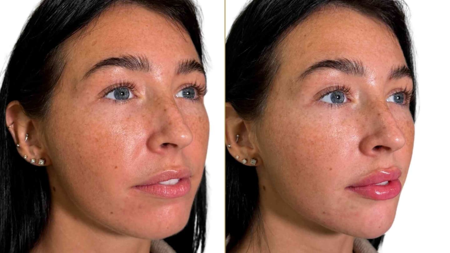 Profile Balancing London - Lower Face rejuvenation