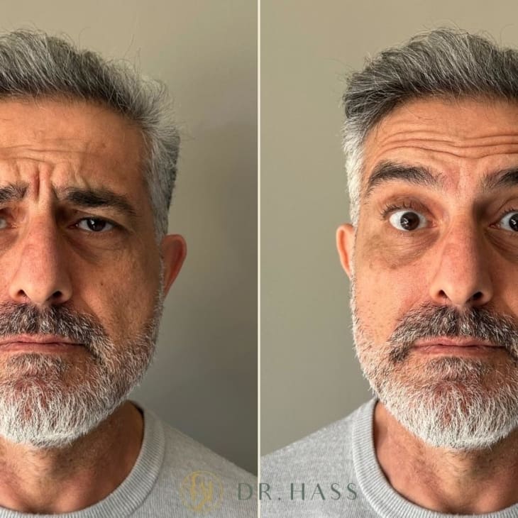 Anti Wrinkle Injections