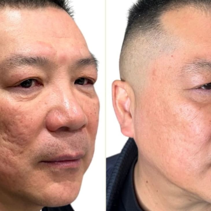 Cosmetic Procedures- microneedling