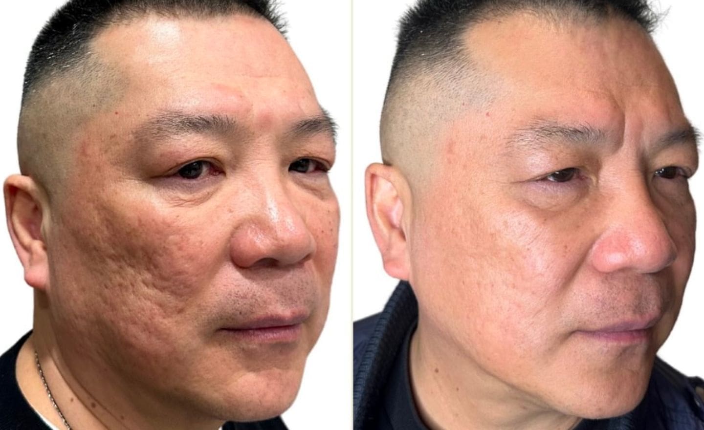 Cosmetic Procedures- microneedling