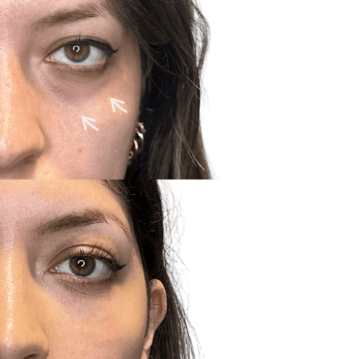 Tear trough filler London
