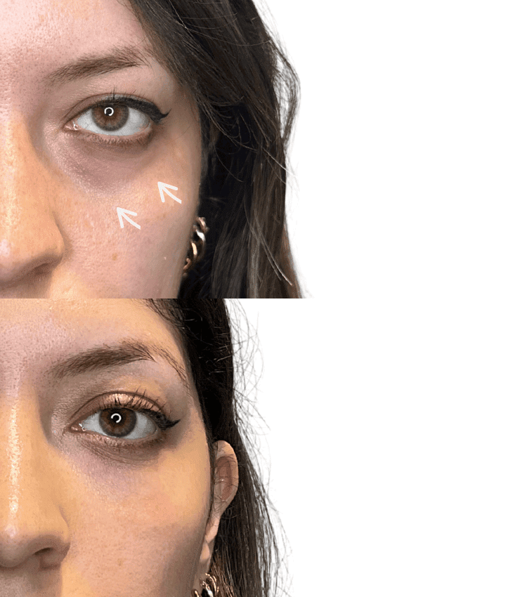 Tear trough filler London
