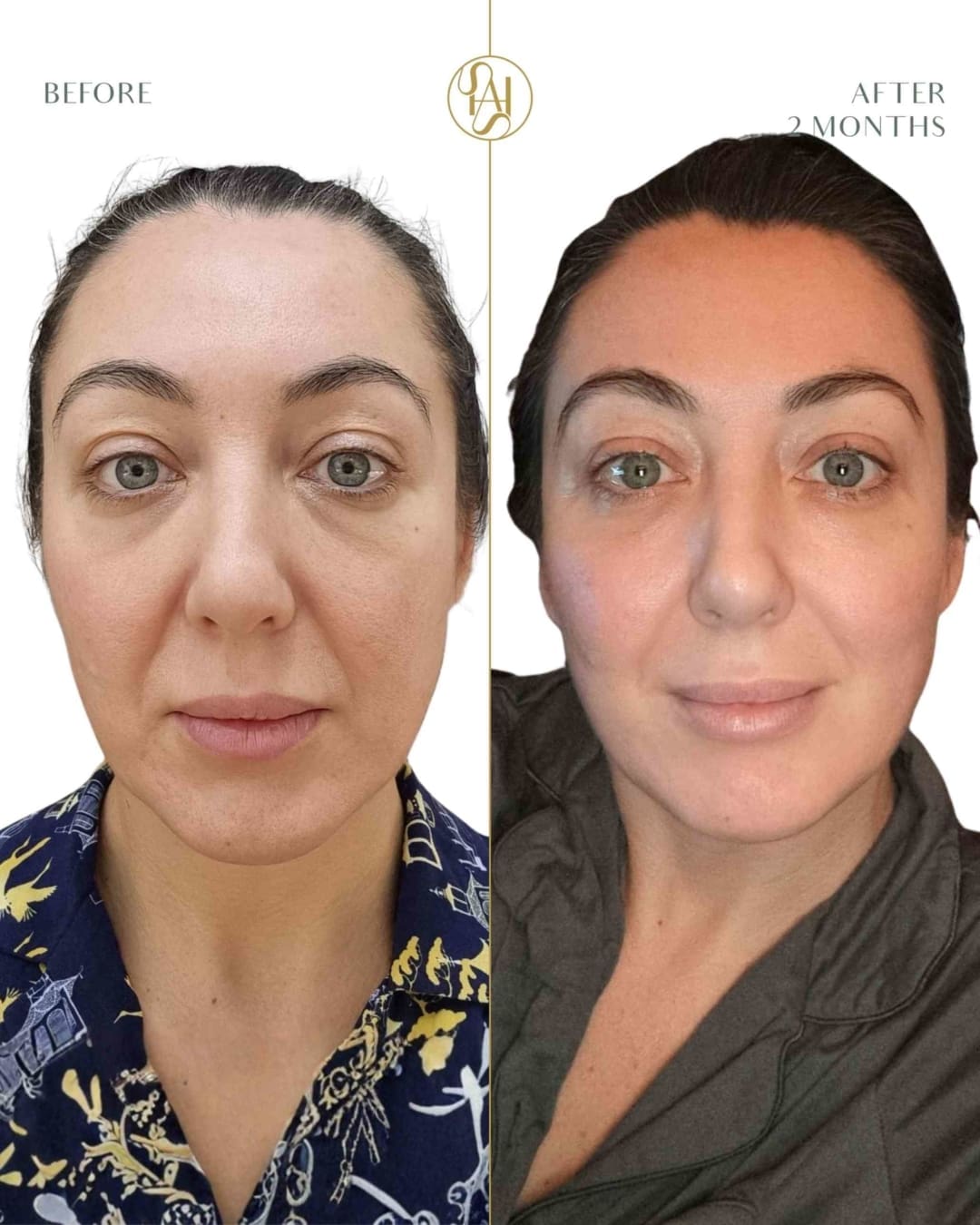 Endolift targeting nasolabial lines and jowls