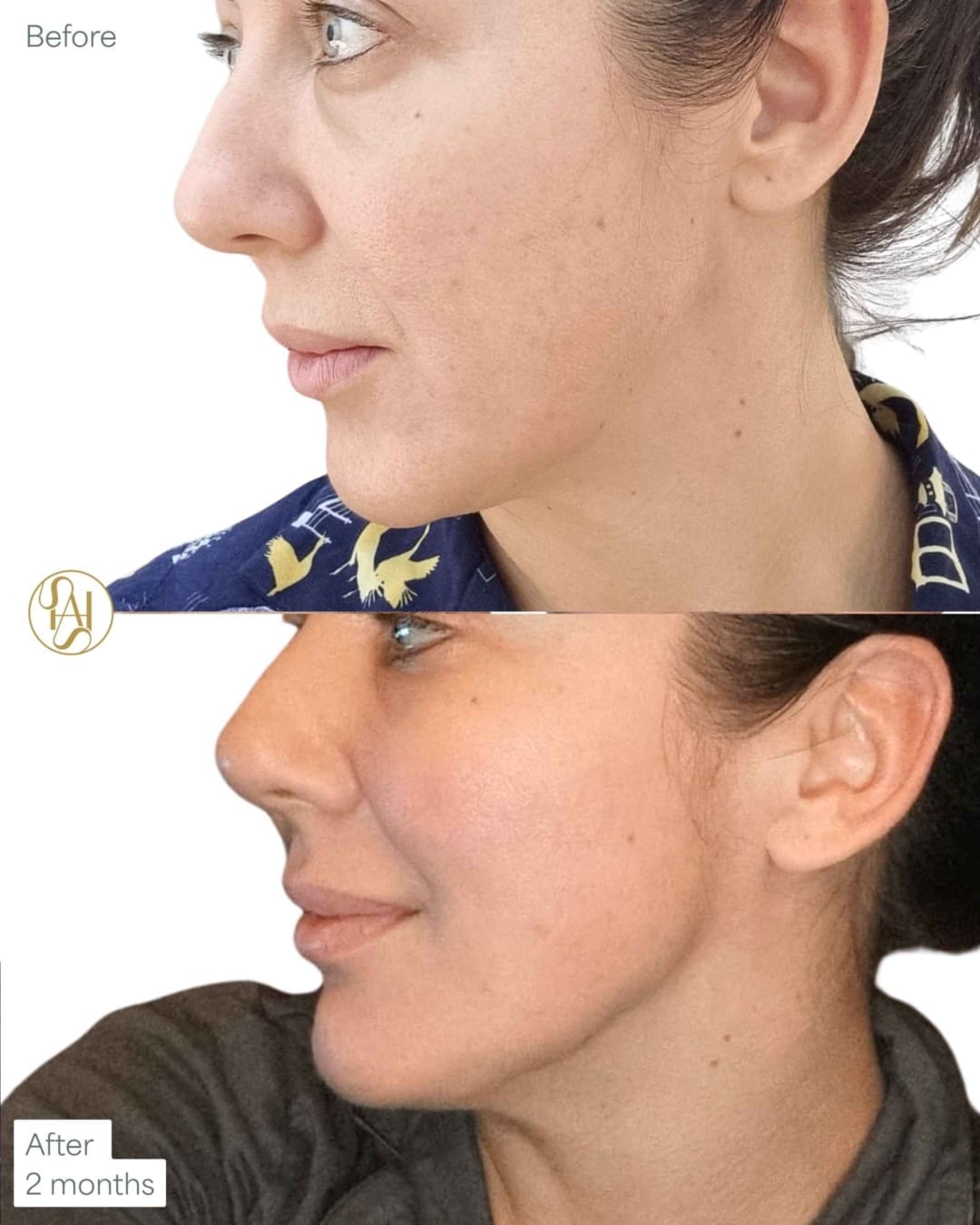 Endolift London Jowls and double chin