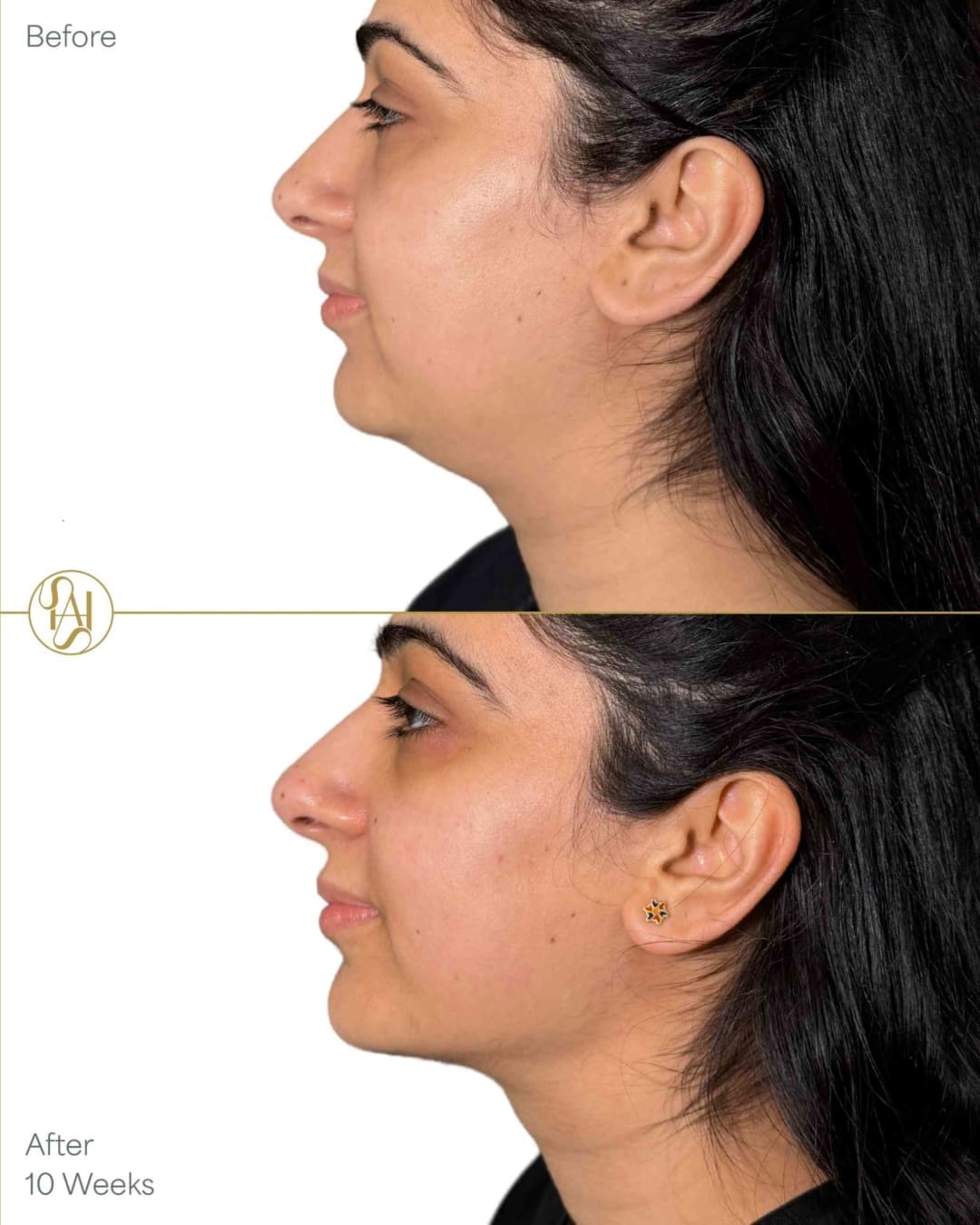 Endolift Before and After Result for Double Chin and Jawline Definition - Dr Hass Clinic in London