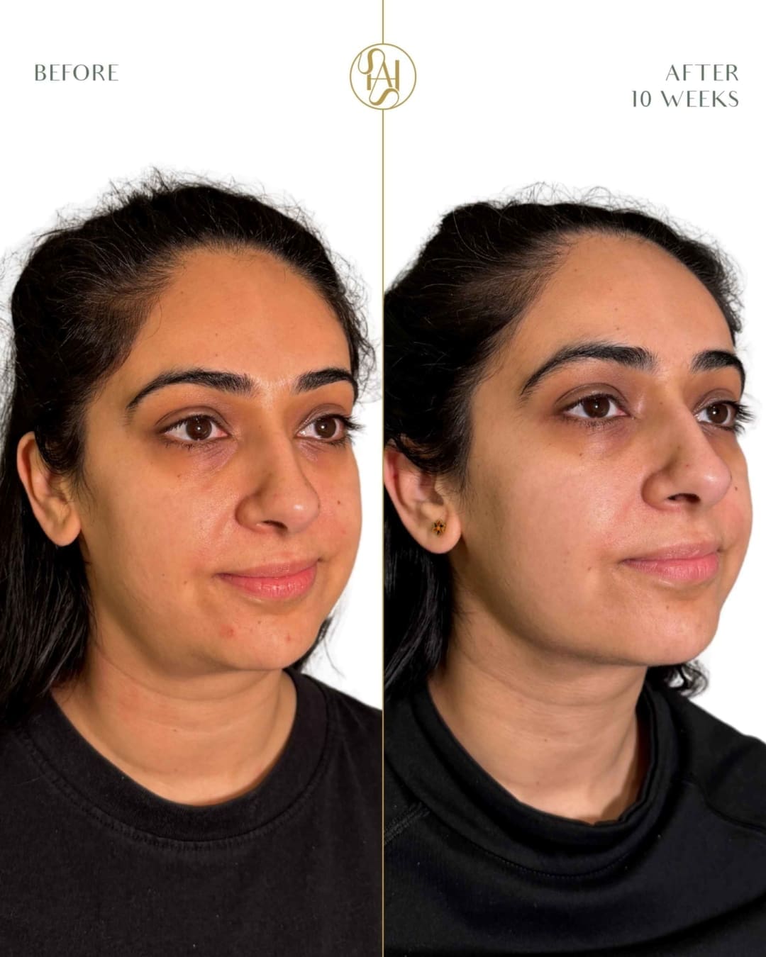 Endolift Before and After Result for Double Chin and Jawline Definition - Dr Hass Clinic in London