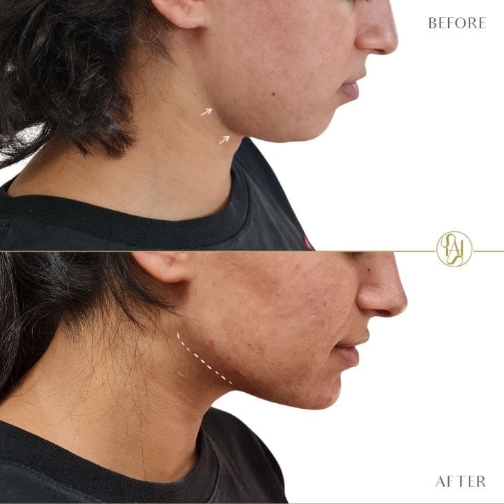 Dr Hass Clinic - Endolift London Skin tightening - non surgical facelift