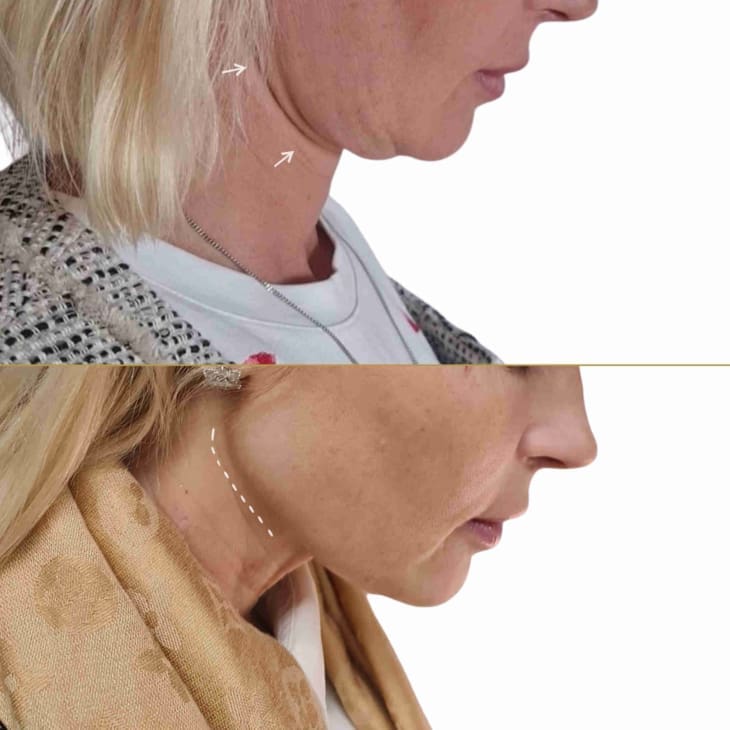 Endolift-before-and-after-2