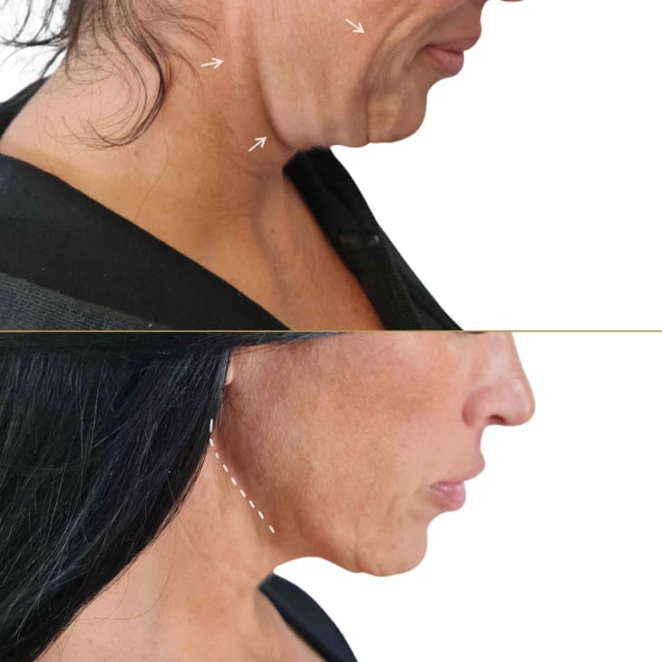 endolift-before-and-after-3
