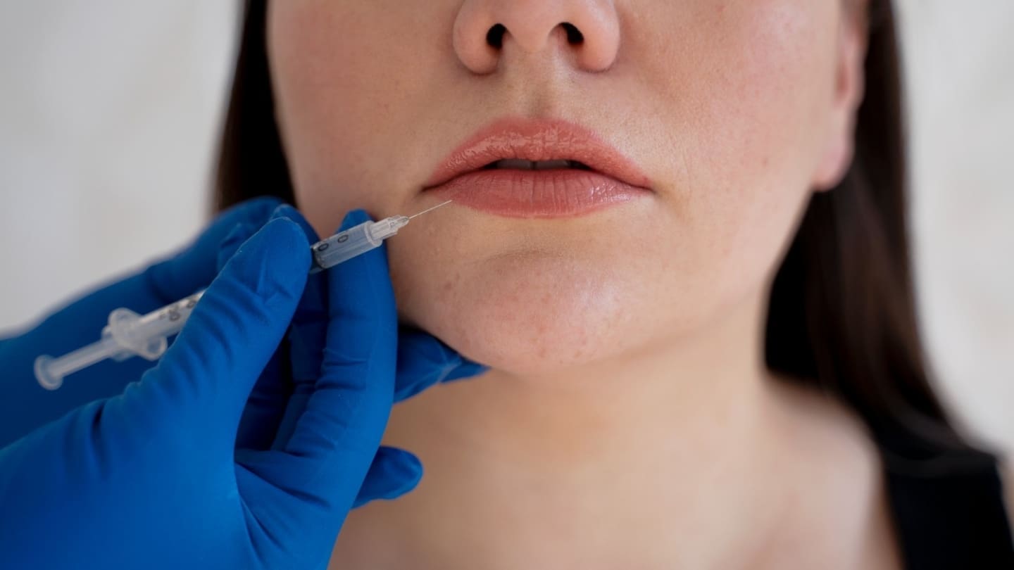 Marionette Filler Stage Image - Dr Hass Clinic