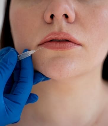 Marionette Filler Stage Image - Dr Hass Clinic