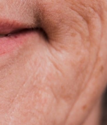 Marionette Filler - Dr Hass Clinic