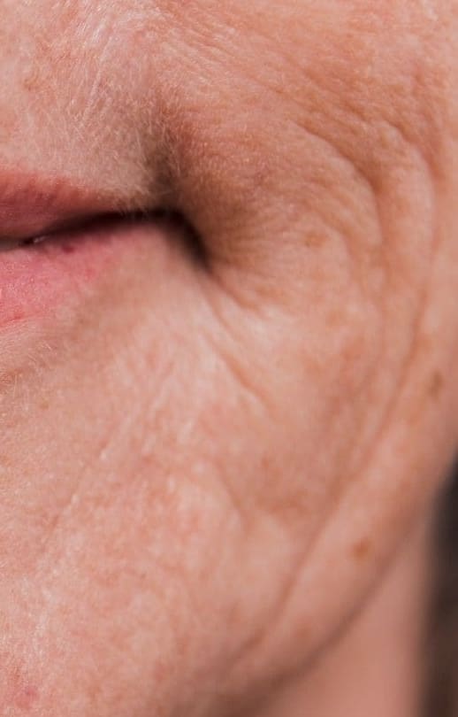 Marionette Filler - Dr Hass Clinic