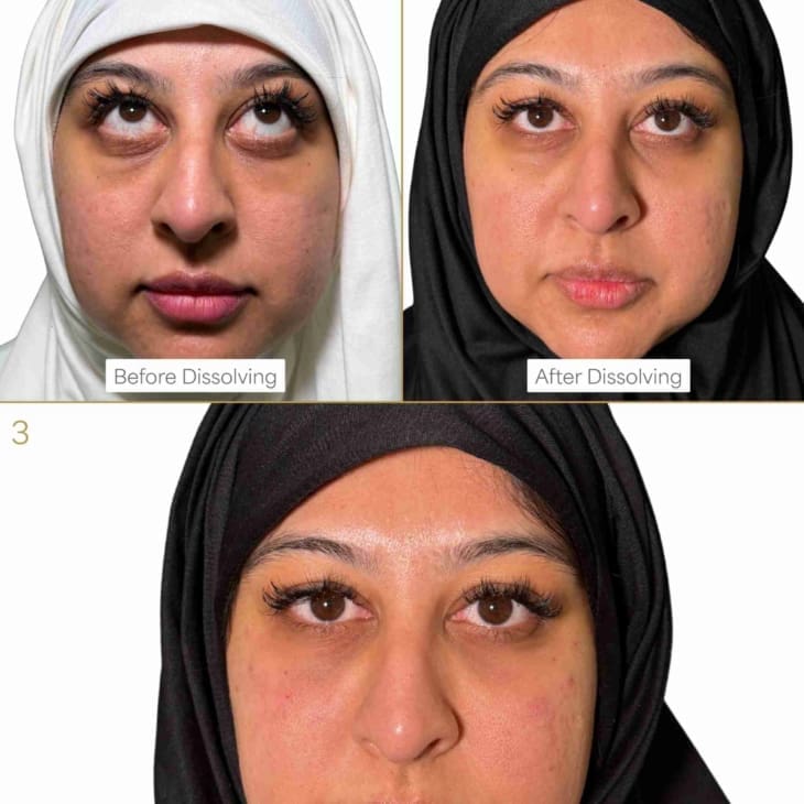 Filler Dissolving Treatment - Before and After - Dr Hass Clinic