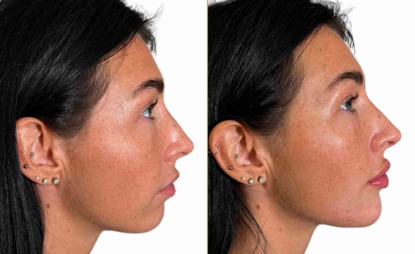 Profile Balancing Side - Female Patient at Dr Hass Clinic London