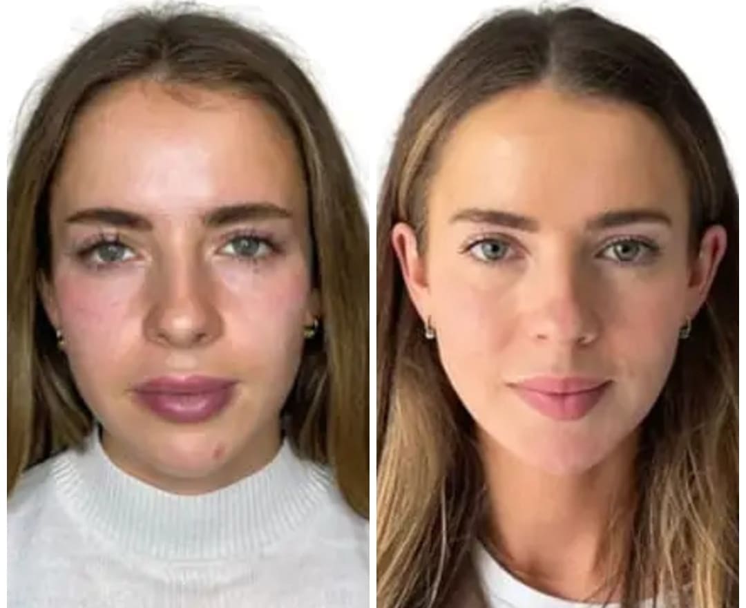Cheek Filler Before and After - Dr Hass Clinic
