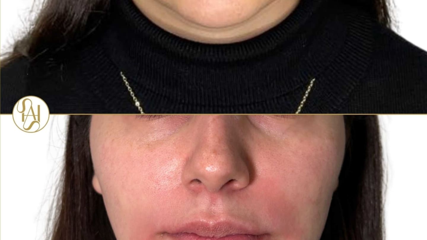 Chin Filler Before and After Results - Dr Hass Clinic London