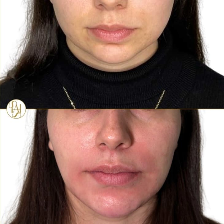 Chin Filler Before and After Results - Dr Hass Clinic London