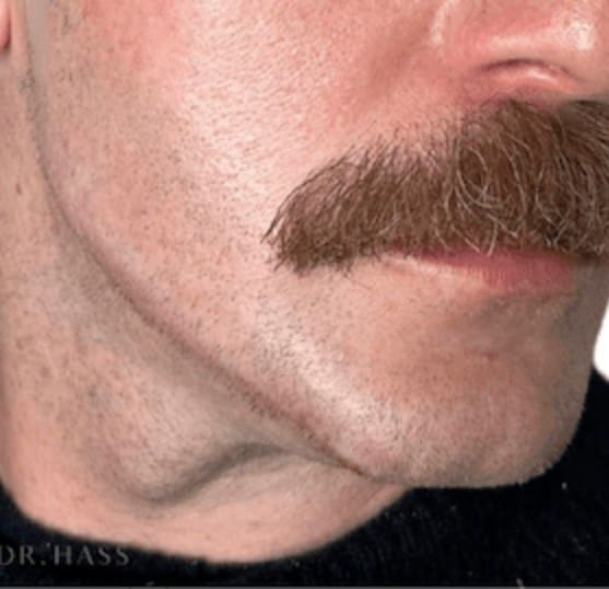 How Facial Masculinisation Fillers Work - Cheeks Chin & Jaw Explained