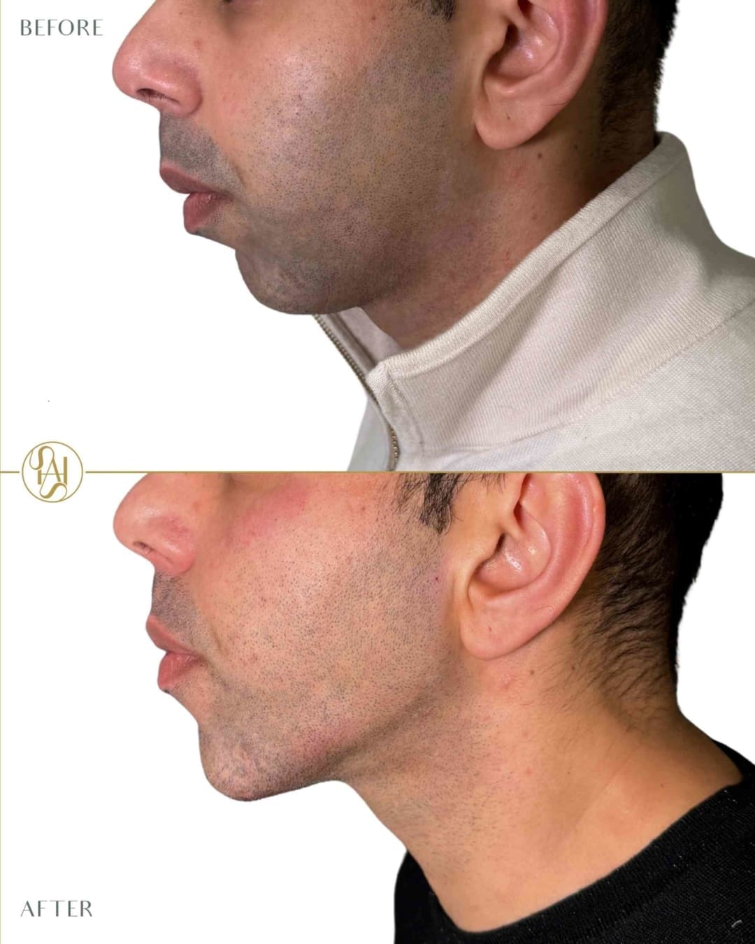 Facial Masculinisation Results - Before and After Treatment - Dr Hass Clinic