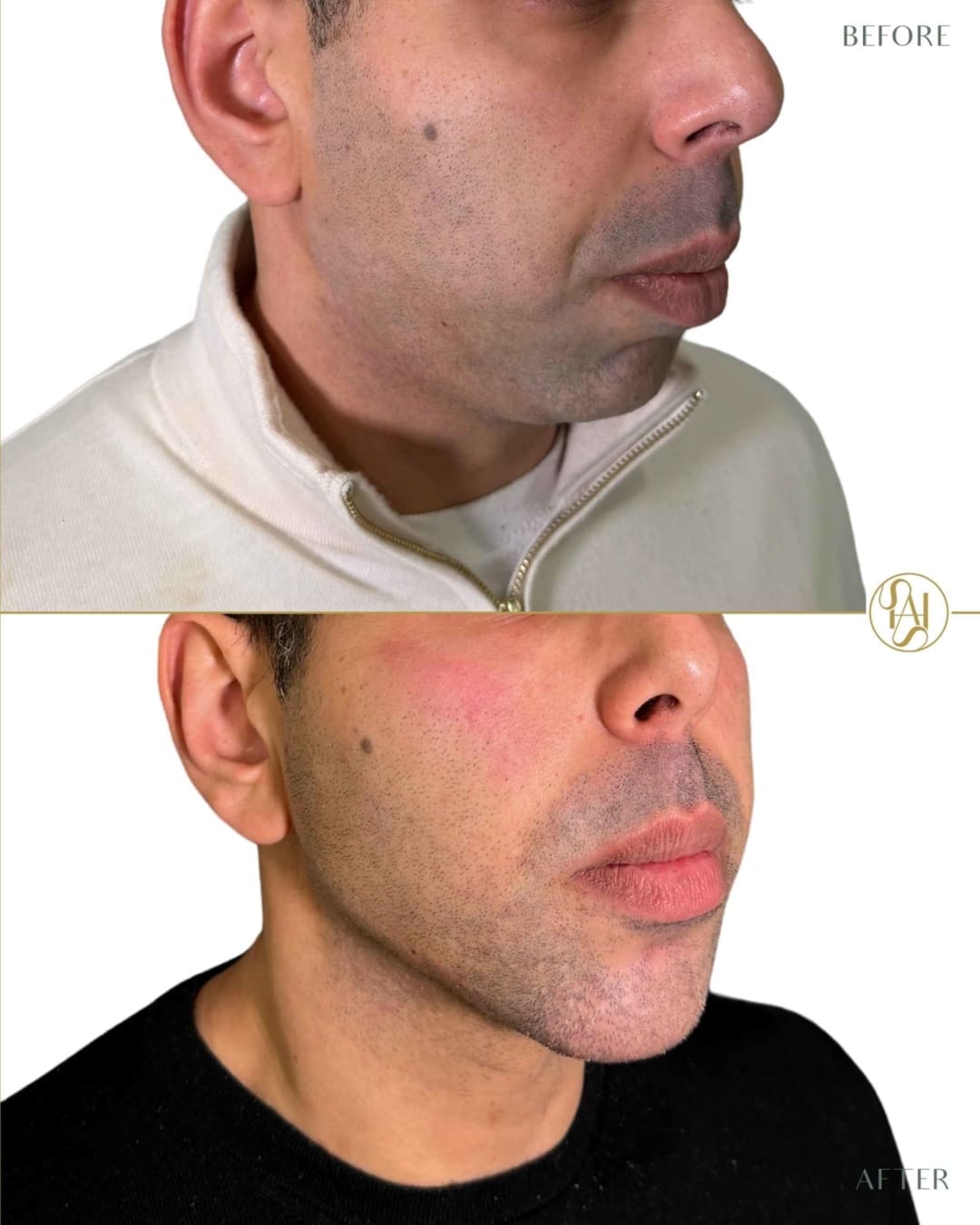 Facial Masculinisation Results - Before and After Treatment - Dr Hass Clinic
