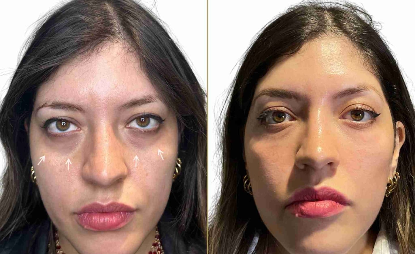 Tear Trough Filler on Female Patient for Dark Circles Before and After Results - Dr Hass Clinic London
