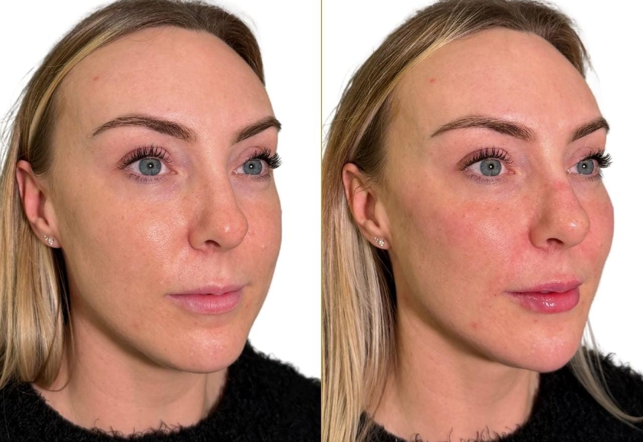 Cheek Filler Before and After - Dr Hass Clinic