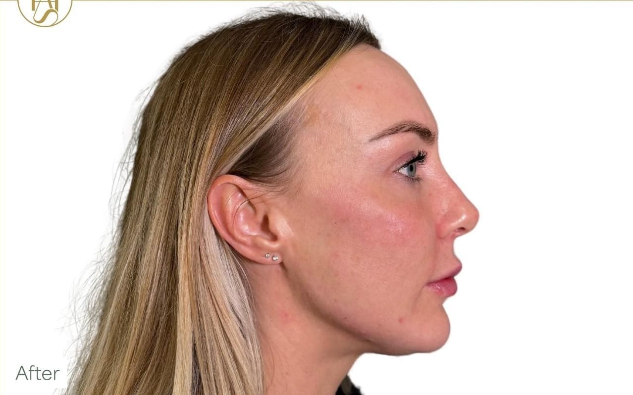 Cheek Filler Woman Side View After - Dr Hass Clinic