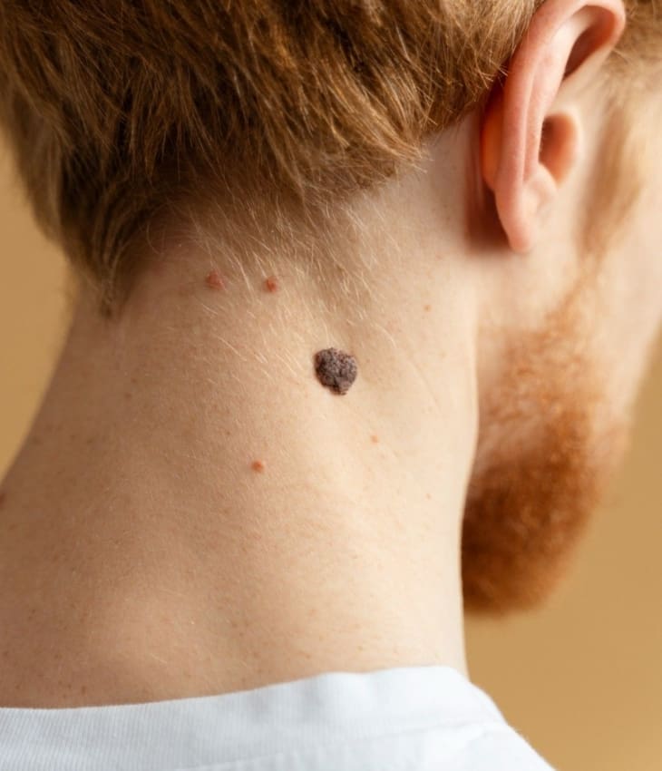 Close Up Young Man with Mole Neck