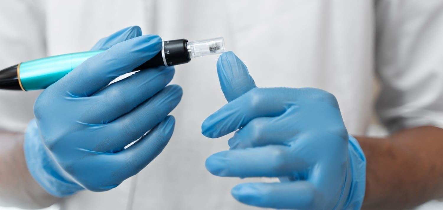 3. Precision Microneedling Treatment: