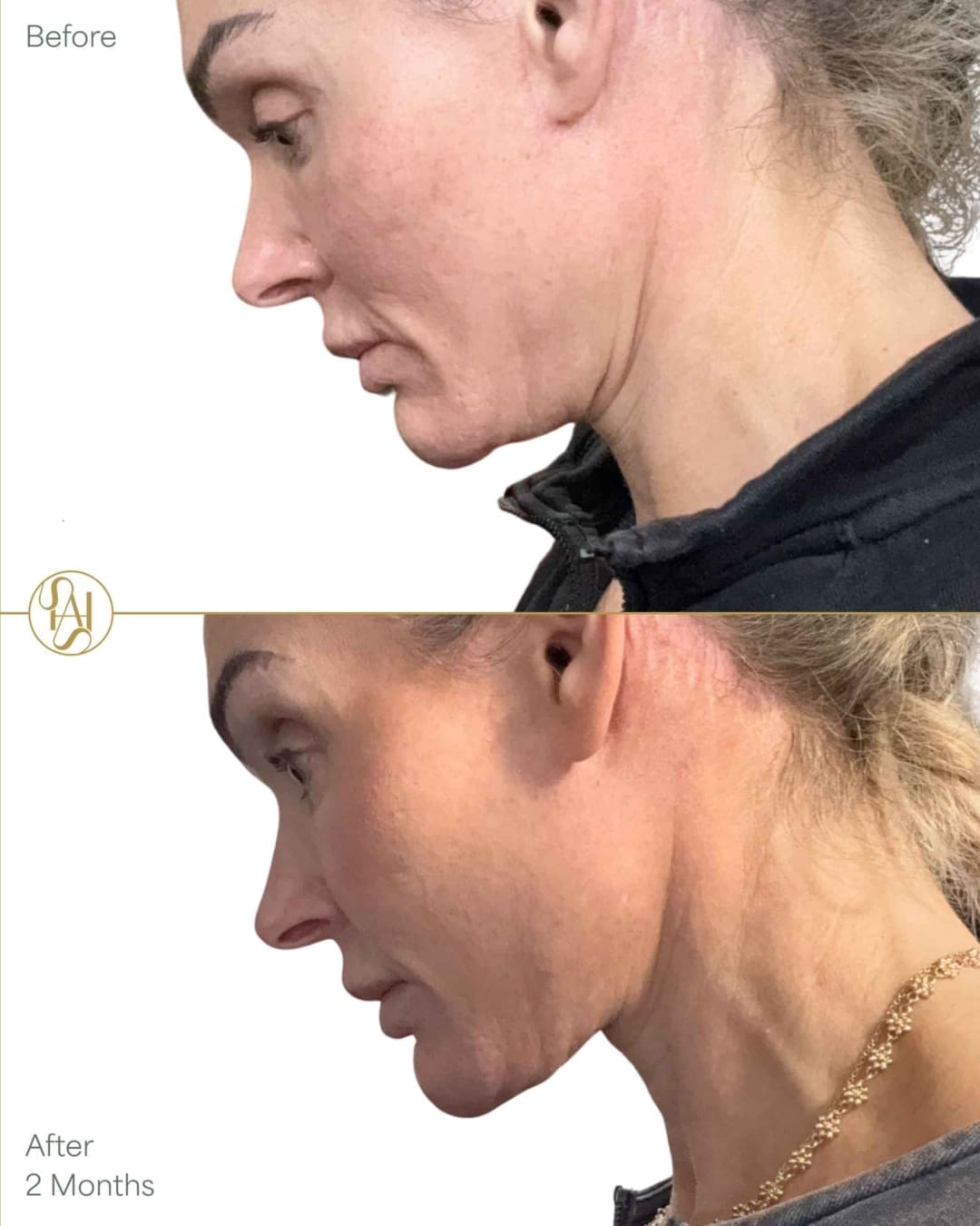 Endolift double chin