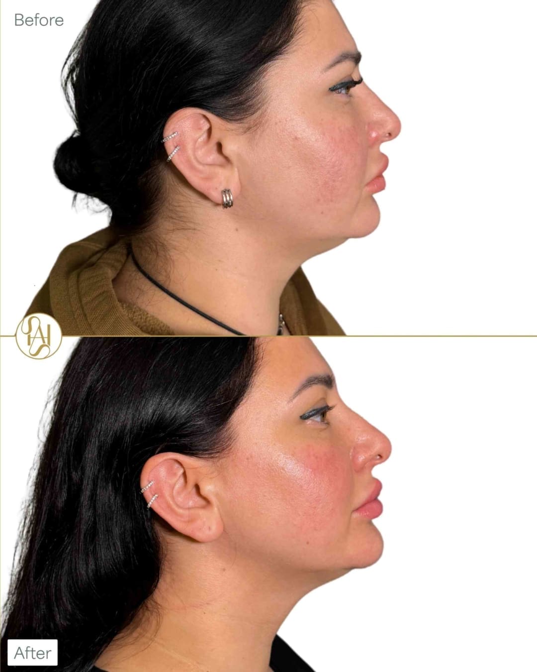 Endolift for Double Chin Before and After Results - Dr Hass Clinic in London