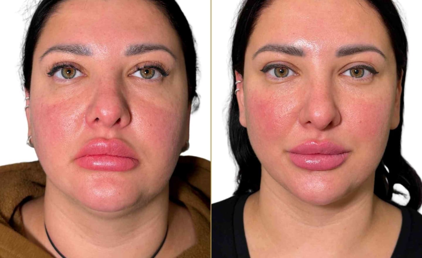 Endolift Laser Full Face Before and After at Dr Hass Clinic London