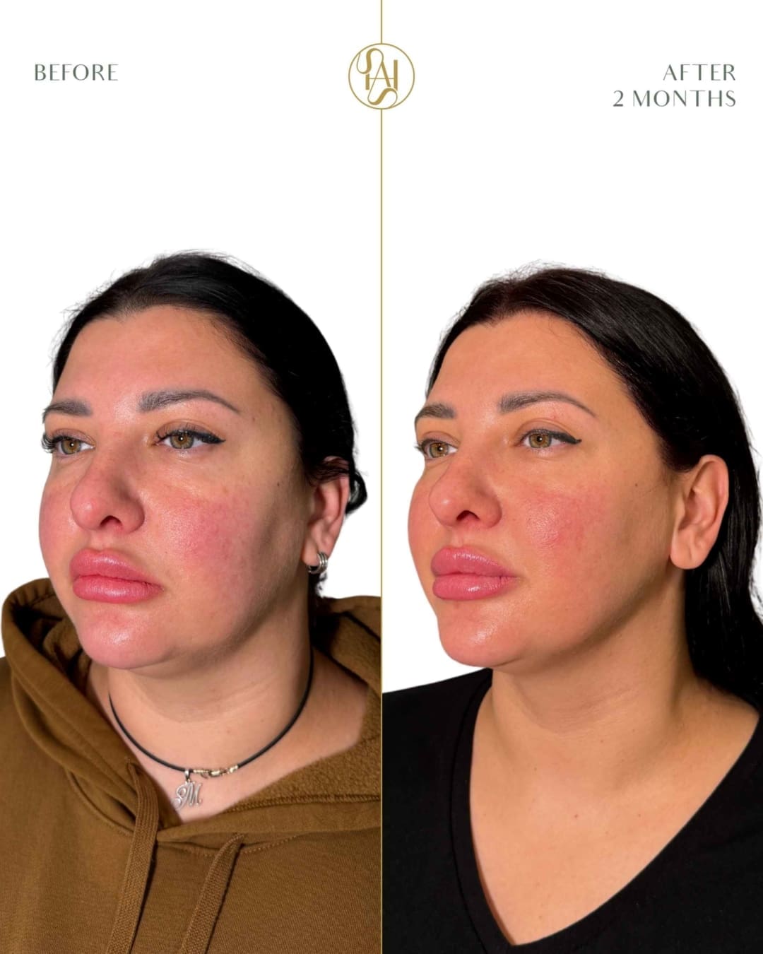 Endolift Full Face Rejuvenation Before and After Results - Dr Hass Clinic in London