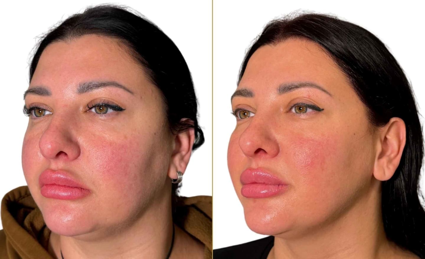 Endolift Full Face Rejuvenation Before and After Results - Dr Hass Clinic in London