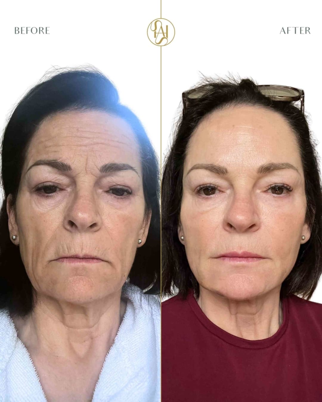 Full Face Rejuvenation