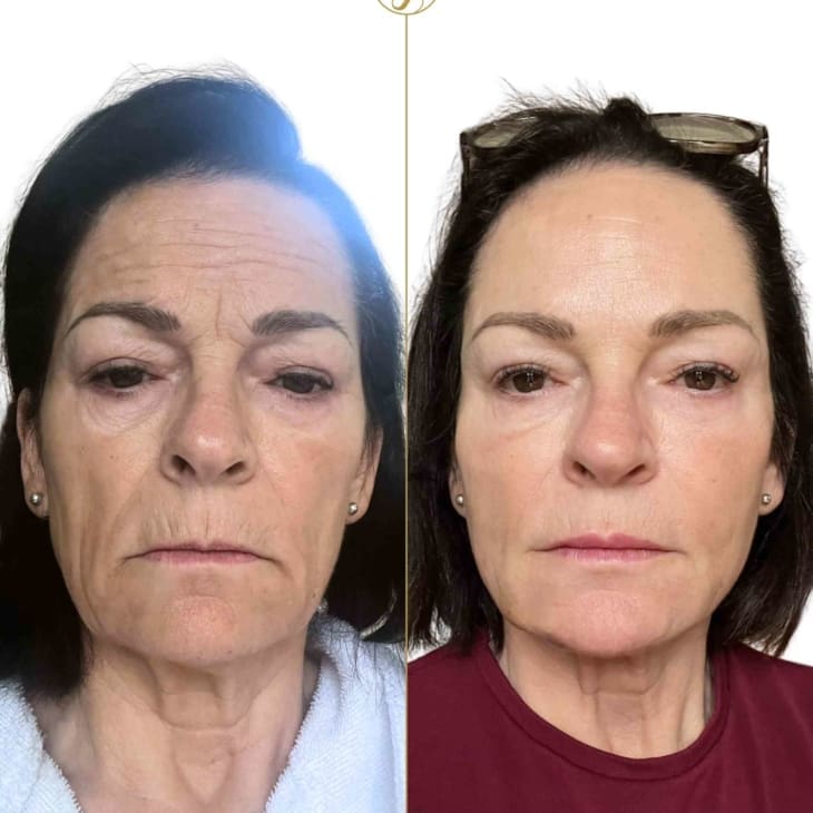 Full Face Rejuvenation